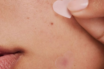 Especialistas em pele dão dicas para remover marcas de acne.