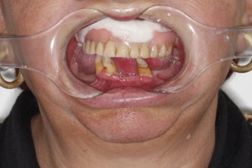 O que o tempo faz com quem perde os dentes