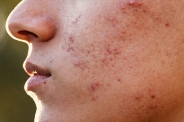 Cicatrizes da Vida: Documentário da La Roche-Posay Explora os Efeitos Visíveis e Ocultos das Marcas na Pele