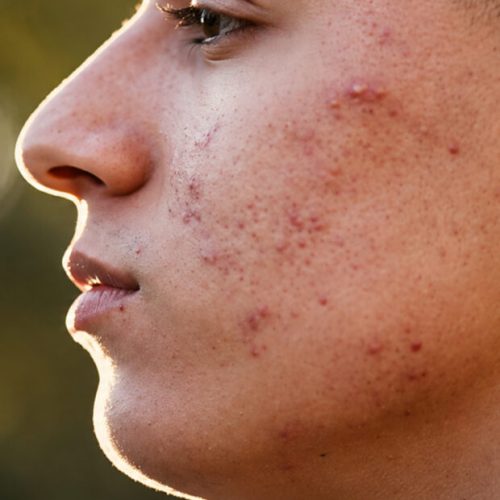 Cicatrizes da Vida: Documentário da La Roche-Posay Explora os Efeitos Visíveis e Ocultos das Marcas na Pele