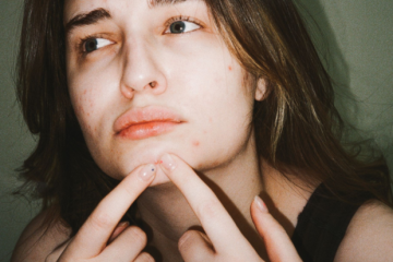 10 soluções eficazes para reduzir marcas de acne