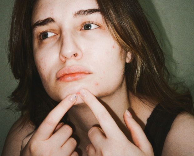 10 soluções eficazes para reduzir marcas de acne